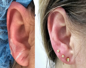 Bezbolesne przekłuwanie uszu pistoletem w gabinecie Oto Ja – metoda zdecydowanie najbardziej komfortowa. Kolczyk jest najpierw umocowany w urządzeniu, które kształtem przypomina pistolet. Pistolet ten przykłada się do ucha i błyskawicznie przekłuwa się ucho wprowadzając od razu kolczyk. Metoda do minimum ogranicza czas zabiegu i jakiekolwiek manipulowanie przy uchu. Dzięki temu stres zwłaszcza małych Pacjentek jest ograniczony do minimum.