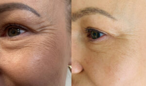 Stymulatory Lenisna i Juvelook zawierają kwas polimlekowy oraz nieusieciowany kwas hialuronowy. Po podaniu działają drażniąco na otaczające tkanki, a to wzbudza proces naprawczy. Fibroblasty namnażają się i intensywnie pracują nad odtworzeniem macierzy międzykomórkowej, w której rośnie ilość kolagenu, elastyny i kwasu hialuronowego. Wraca właściwe nawodnienie, a wraz z nim prawidłowe napięcie i sprężystość skóry. W rejonie podania wyraźnie zwiększa się objętość tkanki, głębokie zmarszczki wyraźnie się spłycają, a płytkie znikają całkowicie.